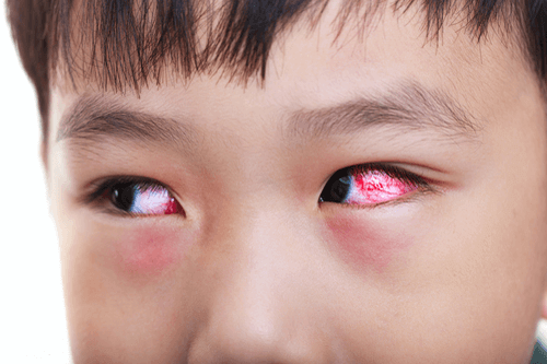 kawasaki disease red eyes - سندرم کاوازاکی؛ تشخیص، درمان و زندگی روزمره