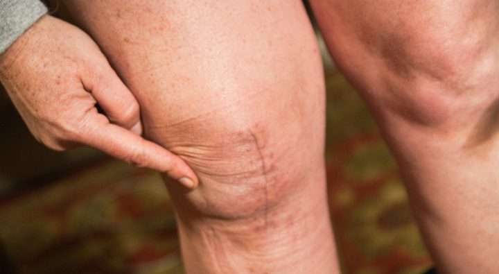 ArkansasSurgicalHospital1 Flickr StevenDepolo 720x395 - هرآنچه که باید درباره ورم پا بعد از جراحی تعویض مفصل زانو بدانید