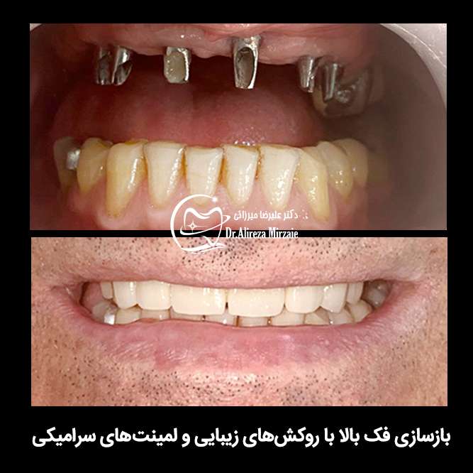 5a0f30a0 b25f 4271 8119 3fdd3c437429 - ایمپلنت فوری چیست و مزایا و معایب ایمپلنت فوری دندان