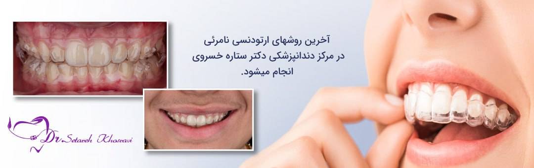 32ec1a06 7011 43b9 8d2b dacf9d7c97ee - ارتودنسی نامرئی: راهی شفاف برای لبخند زیباتر