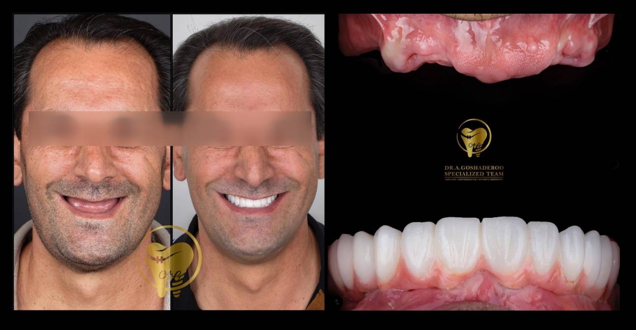 e4ea5d9a a0dd 49e3 b457 3c896fdf88b2 - بازسازی کامل دندان‌ها (Full Mouth Rehabilitation)