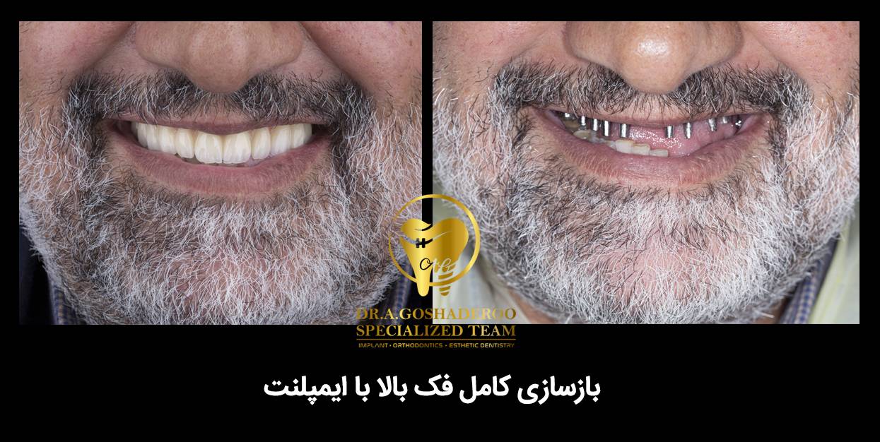 f634ec2f af4d 490b a60c 3ab173cd4678 - بازسازی کامل دندان‌ها (Full Mouth Rehabilitation)